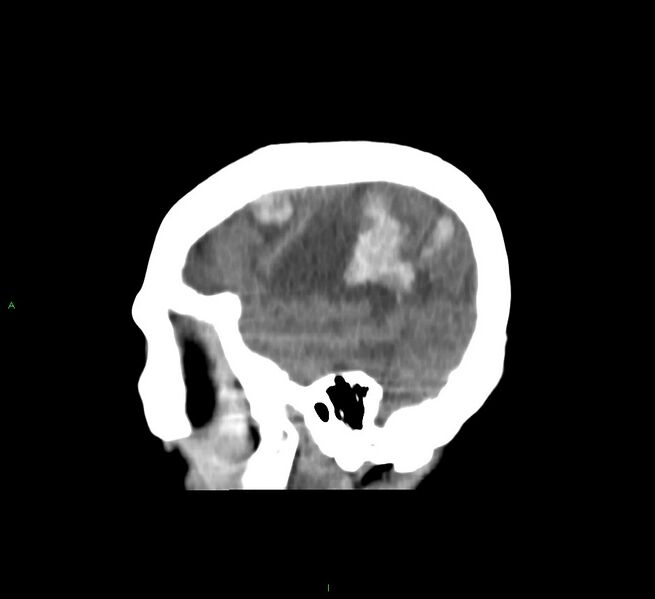 File:Cerebral amyloid angiopathy-associated lobar intracerebral hemorrhage (Radiopaedia 58751-65972 C 12).jpg