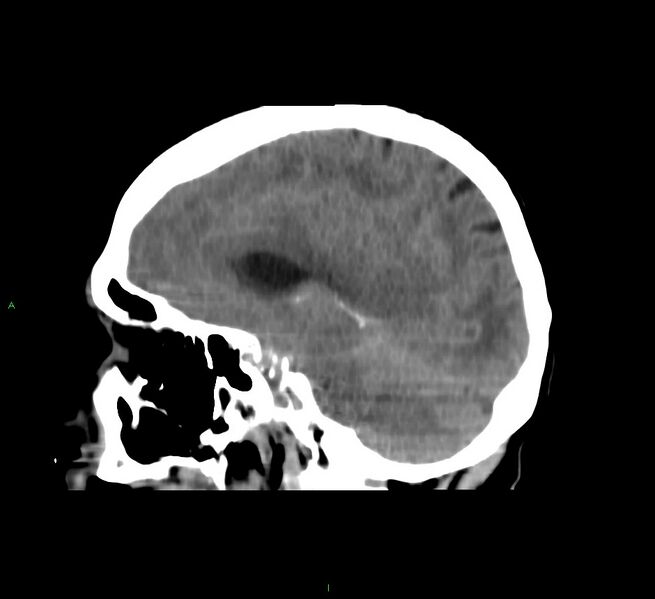 File:Cerebral amyloid angiopathy-associated lobar intracerebral hemorrhage (Radiopaedia 58751-65972 C 33).jpg