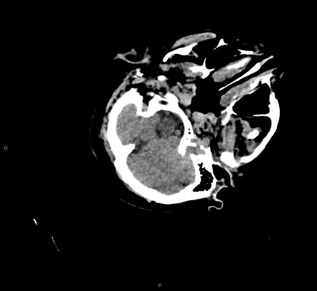 File:Cerebral amyloid angiopathy-associated lobar intracerebral hemorrhage (Radiopaedia 58757-65979 Axial non-contrast 25).jpg