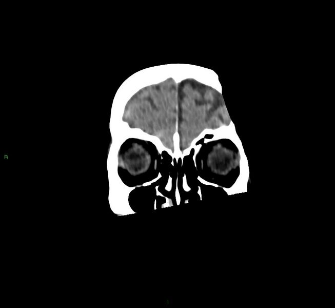 File:Cerebral amyloid angiopathy-associated lobar intracerebral hemorrhage (Radiopaedia 58758-65980 Coronal non-contrast 54).jpg