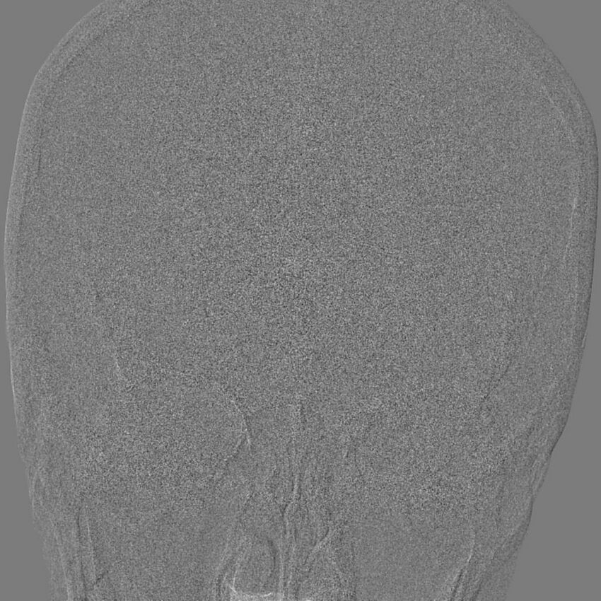 Cerebral aneurysm with rupture (Radiopaedia 29933-30458 LT ICA IC 9).jpg