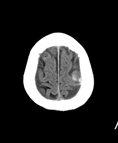 File:Cerebral contusions, subarachnoid hemorrhage and subdural hygromas (Radiopaedia 55399-61828 Axial non-contrast 25).png
