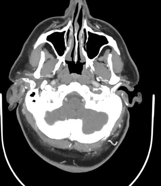 File:Cerebral dural venous sinus thrombosis (Radiopaedia 86514-102576 A 26).jpg