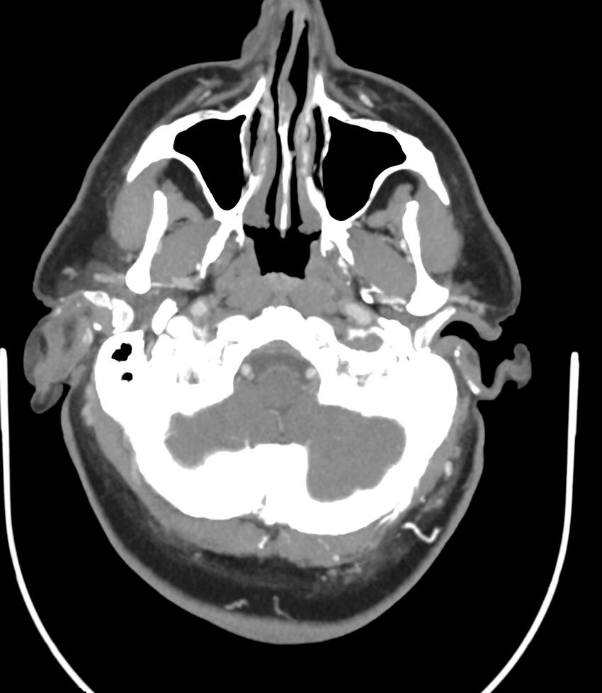 Cerebral dural venous sinus thrombosis (Radiopaedia 86514-102576 A 26).jpg