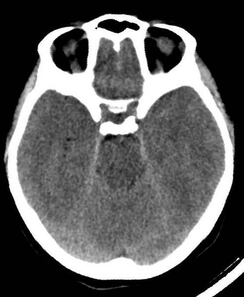 File:Cerebral edema due to severe hyponatremia (Radiopaedia 89826-106937 Axial non-contrast 32).jpg