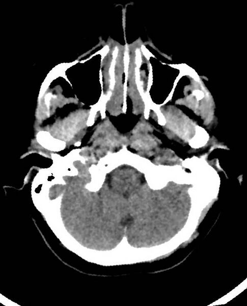 File:Cerebral edema due to severe hyponatremia (Radiopaedia 89826-106938 Axial non-contrast 18).jpg