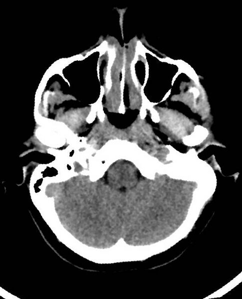 File:Cerebral edema due to severe hyponatremia (Radiopaedia 89826-106938 Axial non-contrast 20).jpg