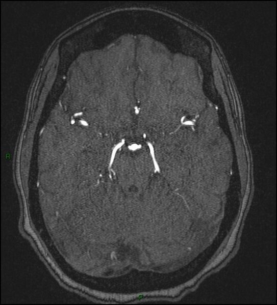 File:Cerebral fat embolism (Radiopaedia 35022-36525 Axial TOF 76).jpg