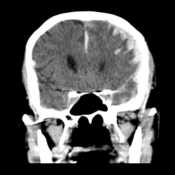 File:Cerebral hemorrhagic contusions (Radiopaedia 23145-23188 Coronal non-contrast 16).jpg