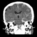 Cerebral hemorrhagic contusions (Radiopaedia 23145-23188 Coronal non-contrast 25).jpg