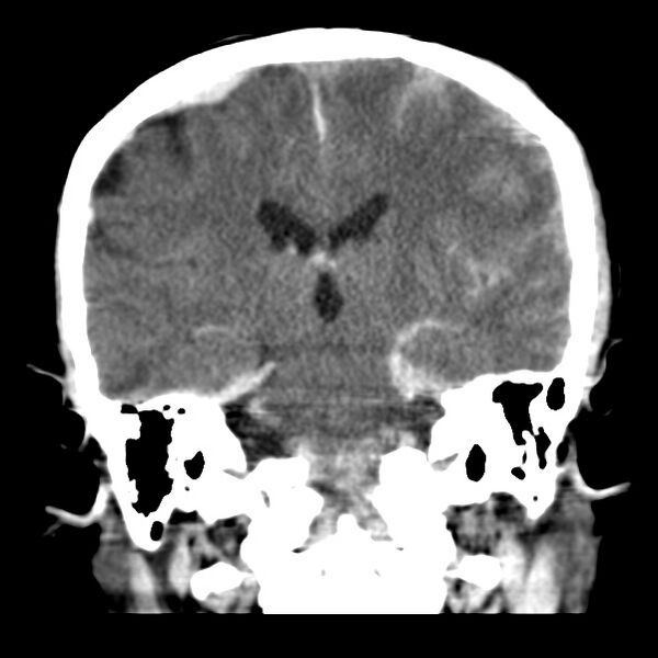 File:Cerebral hemorrhagic contusions (Radiopaedia 23145-23188 Coronal non-contrast 25).jpg
