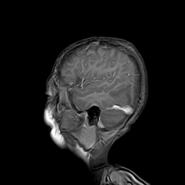 File:Cerebral tuberculoma (Radiopaedia 41152-43932 Sagittal T1 C+ 16).jpg