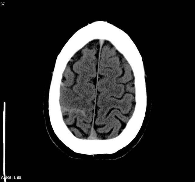 File:Cerebral vein thrombosis (Radiopaedia 4408-6628 Axial non-contrast 4).jpg