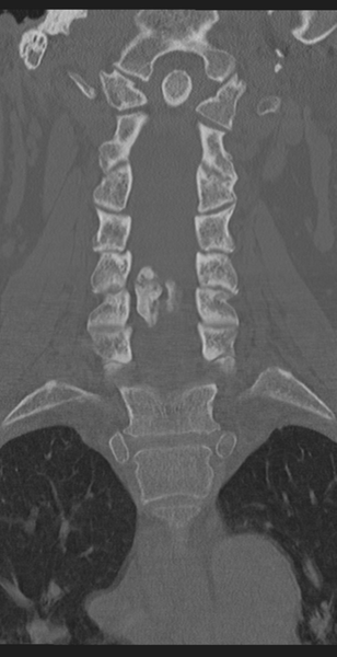 File:Cervical canal stenosis - OPLL and osteophytes (Radiopaedia 47329-51910 Coronal bone window 27).png