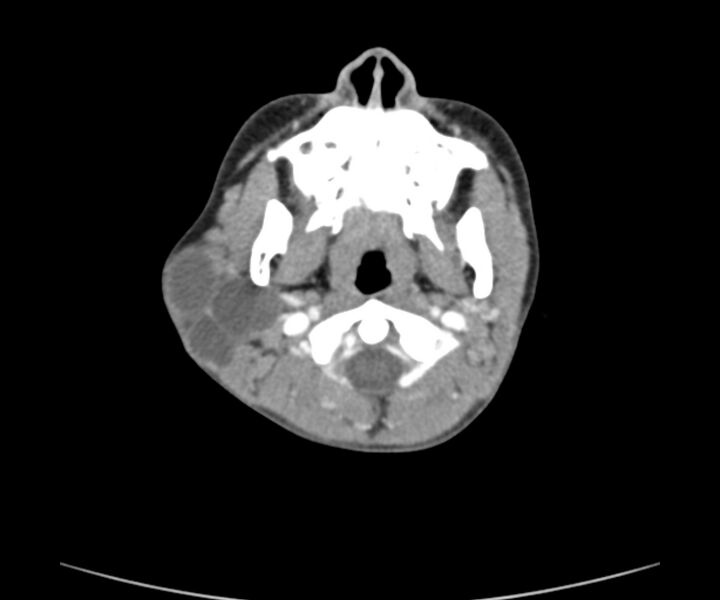 File:Cervical cystic lymphangioma (Radiopaedia 63655-72332 Axial + contrast 7).jpg