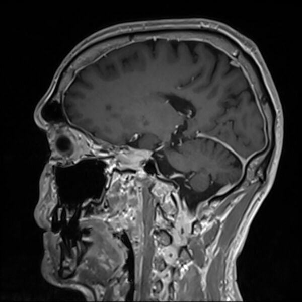 File:Cervical dural CSF leak on MRI and CT treated by blood patch (Radiopaedia 49748-54995 G 71).jpg