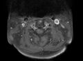 Cervical schwannoma (Radiopaedia 72399-82934 Axial T1 C+ fat sat 4).jpg