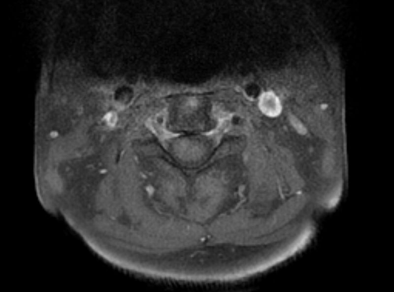 File:Cervical schwannoma (Radiopaedia 72399-82934 Axial T1 C+ fat sat 4).jpg