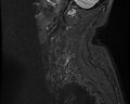Cervical schwannoma (Radiopaedia 72399-82934 Sagittal STIR 1).jpg