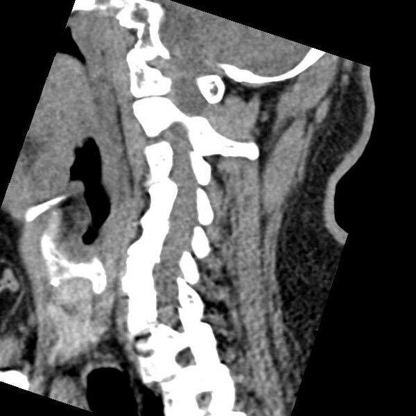 File:Cervical spinal neurofibroma in a patient with NF1 (Radiopaedia 58344-65464 C 33).jpg