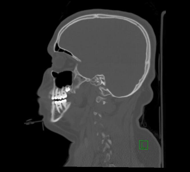 File:Cervical spine fracture - hyperflexion injury (Radiopaedia 66184-75364 A 5).jpg