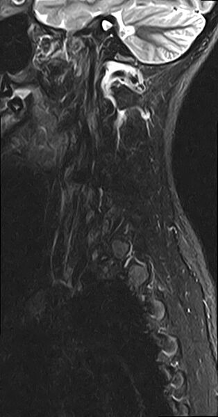 File:Cervical spondylodiscitis and calvarial hemangioma (Radiopaedia 64317-73104 Sagittal STIR 13).jpg