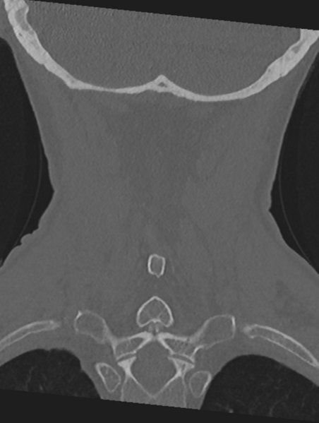 File:Cervical spondylolysis (Radiopaedia 49616-54811 Coronal bone window 47).png