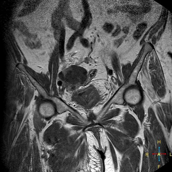 File:Cervical stump squamous cell carcinoma (Radiopaedia 48049-52858 Coronal T1 C+ 3).jpg