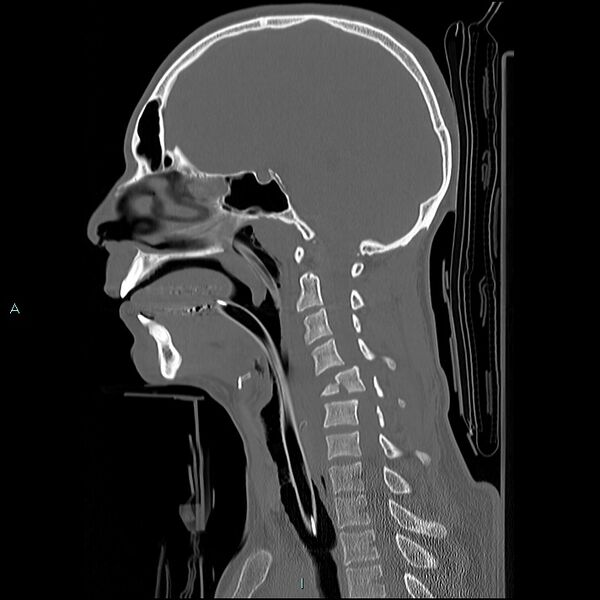 File:Cervical vertebral burst fracture (Radiopaedia 37420-39258 Sagittal bone window 17).jpg