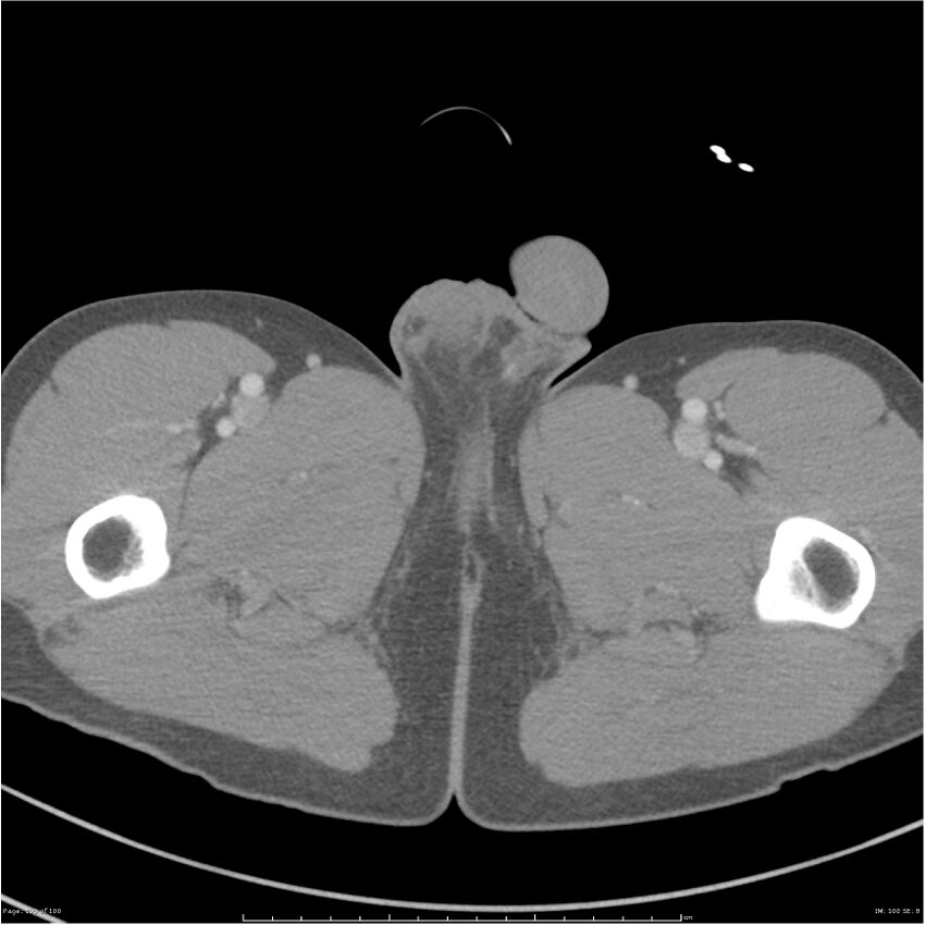 Chest and abdomen multi-trauma (Radiopaedia 26294-26426 bone window 100).jpg