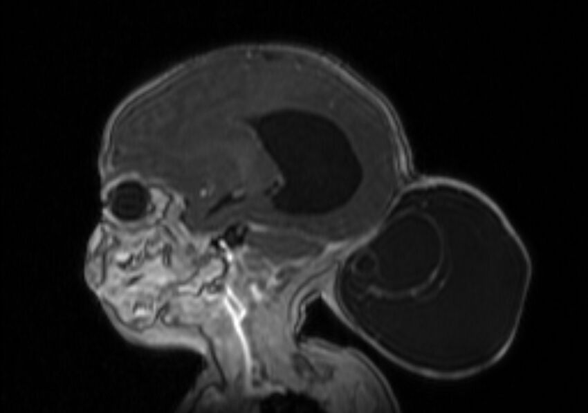 Chiari III malformation with occipital encephalocele (Radiopaedia 79446-92559 Sagittal T1 C+ mpr 27).jpg