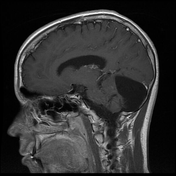 File:Chiasmatic-hypothalamic juvenile pilocytic astrocytoma (Radiopaedia 78533-91236 Sagittal T1 C+ 11).jpg