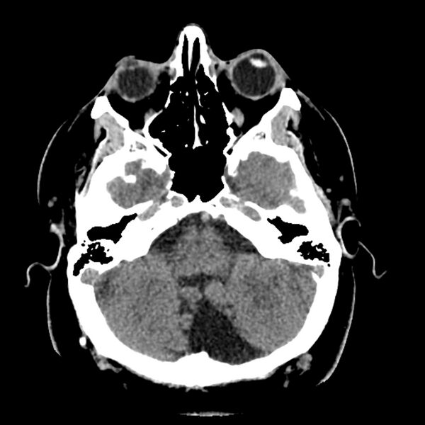 File:Chiasmatic-hypothalamic juvenile pilocytic astrocytoma (Radiopaedia 78533-91237 Axial non-contrast 15).jpg