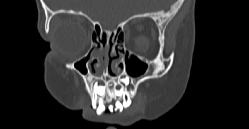 Choanal atresia (Radiopaedia 51295-56972 Coronal bone window 18).jpg