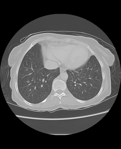 File:Chondrosarcoma (Radiopaedia 79427-92532 Axial lung window 43).jpg