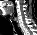 Chondrosarcoma - larynx (Radiopaedia 4588-6698 C 7).jpg