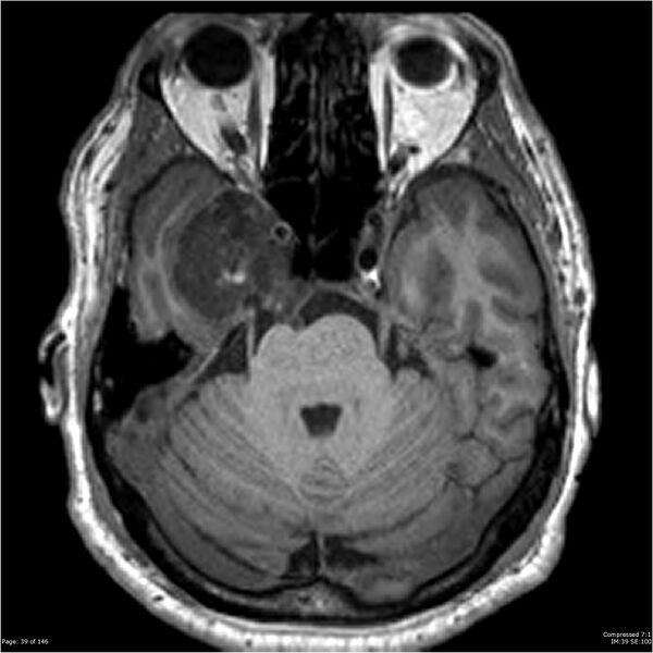 File:Chondrosarcoma of skull base- grade II (Radiopaedia 40948-43654 Axial T1 39).jpg