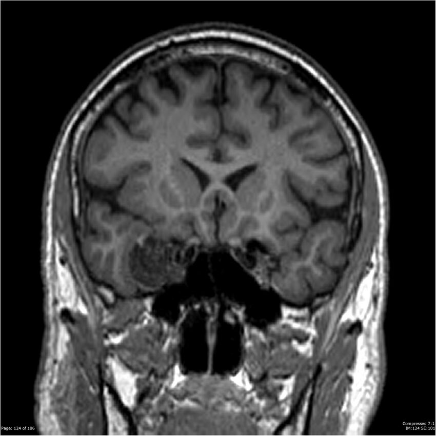 Chondrosarcoma of skull base- grade II (Radiopaedia 40948-43654 Coronal T1 45).jpg