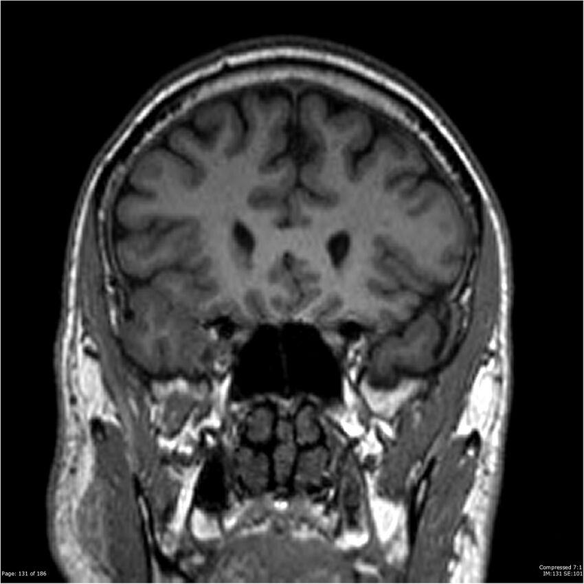 Chondrosarcoma of skull base- grade II (Radiopaedia 40948-43654 Coronal T1 52).jpg