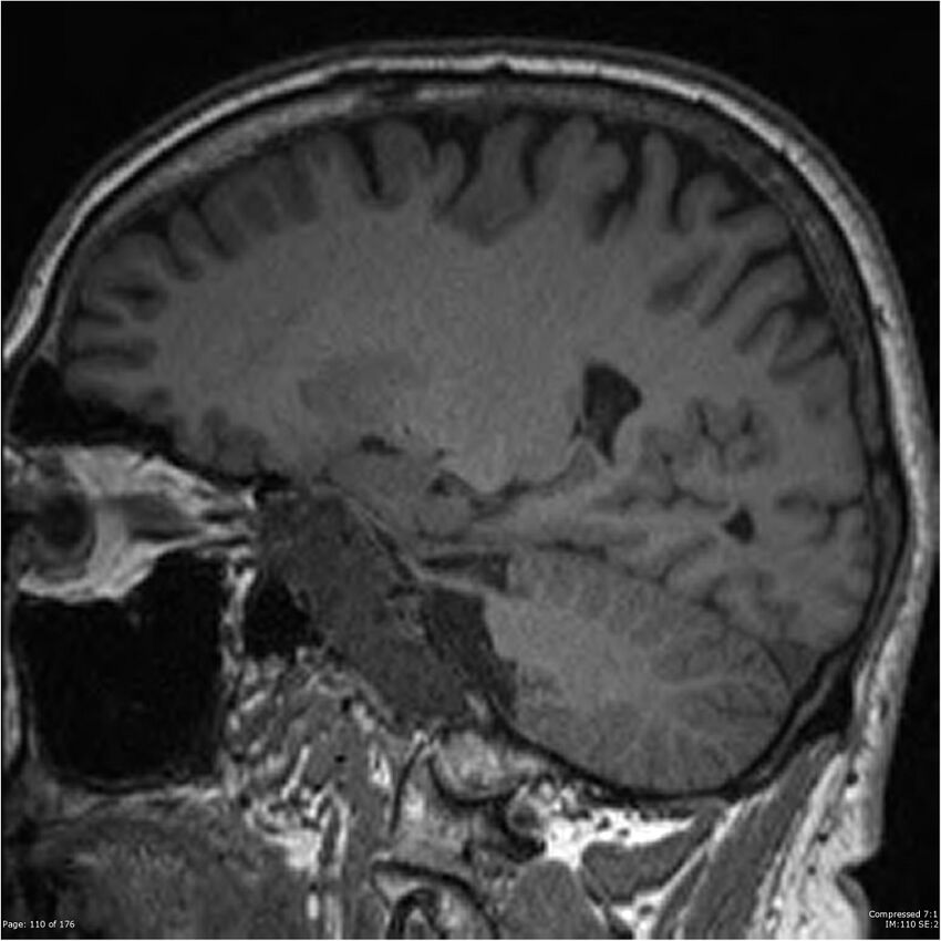 Chondrosarcoma of skull base- grade II (Radiopaedia 40948-43654 Sagittal T1 33).jpg