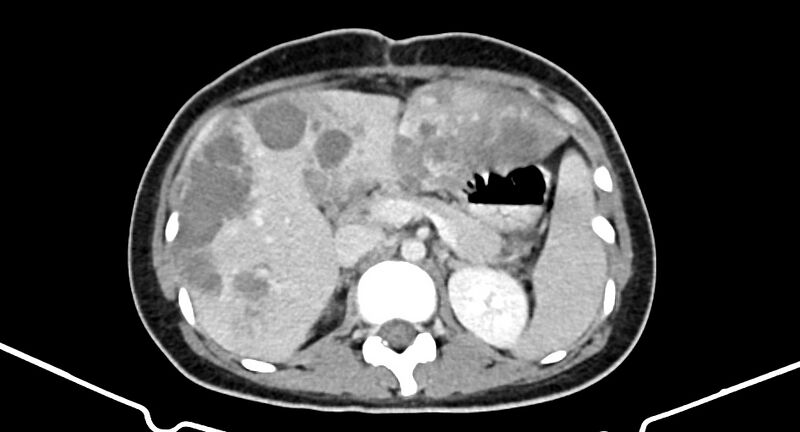 File:Choriocarcinoma liver metastases (Radiopaedia 74768-85766 A 77).jpg