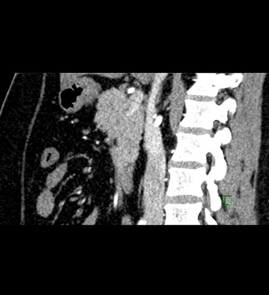 File:Chromophobe renal cell carcinoma (Radiopaedia 84286-99573 F 92).jpg
