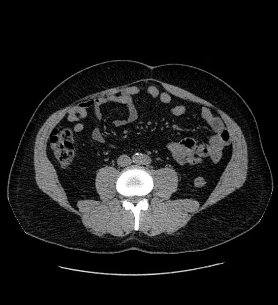 File:Chromophobe renal cell carcinoma (Radiopaedia 84337-99693 Axial non-contrast 84).jpg