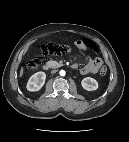 File:Chromophobe renal cell carcinoma (Radiopaedia 86879-103083 B 63).jpg