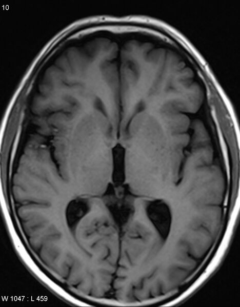 File:Chronic lymphocytic inflammation with pontine perivascular enhancement responsive to steroids (CLIPPERS) (Radiopaedia 37520-39374 Axial T1 9).jpg