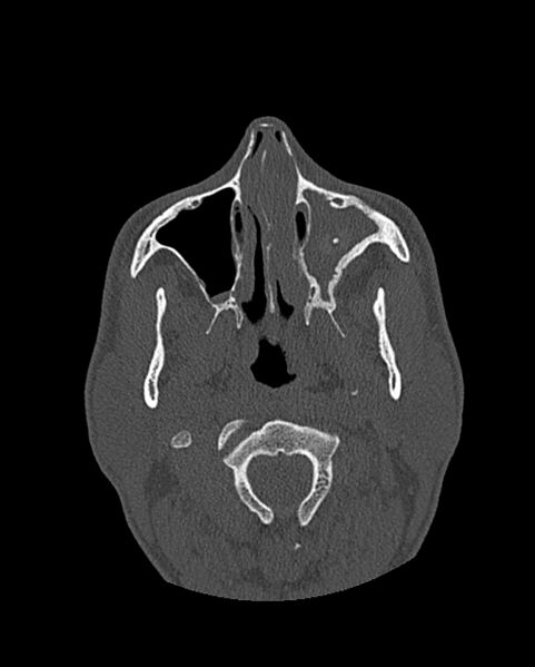 File:Chronic maxillary sinusitis caused by a foreign body (Radiopaedia 58521-65676 Axial bone window 108).jpg