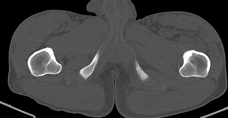 File:Chronic osteomyelitis (with sequestrum) (Radiopaedia 74813-85822 Axial non-contrast 57).jpg