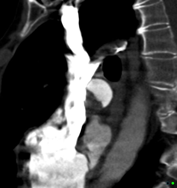 File:Chronic pulmonary embolism (Radiopaedia 17943-17702 Sagittal C+ CTPA 17).jpg