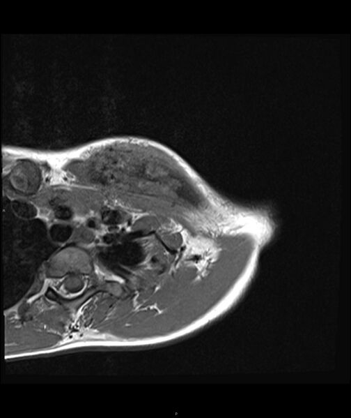 File:Chronic reactive multifocal osteomyelitis (CRMO) - clavicle (Radiopaedia 56406-63071 Axial T1 7).jpg