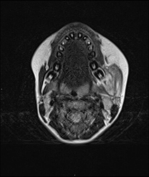 File:Chronic reactive multifocal osteomyelitis (CRMO) - mandible (Radiopaedia 56405-63069 Axial T2 11).jpg